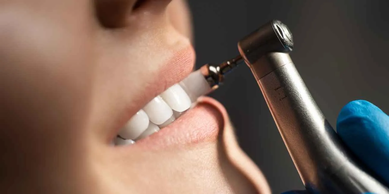 تفاوت جرم گیری و بلیچینگ دندان چیست؟ | بررسی کامل دکتر حسین شیرزادی